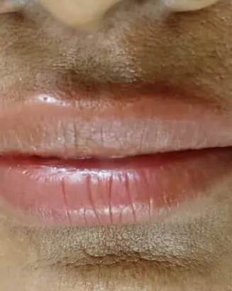 After: the same lips in the same framing, lighter and more even in tone.