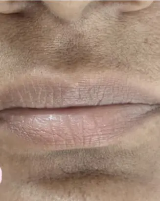 Before: close-up of lips with dark, uneven pigmentation.